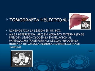  TOMOGRAFIA



HELICOIDAL:

DIAGNOSTICA LA LESION EN UN 80%.
MASA HIPERDENSA, ARQ EN MOSAICO INTERNA (FASE
PRECOZ), LESION ISODENSA EN RELACION AL
PARENQUIMA (FASE PORTAL); LESION HIPODENSA
RODEADA DE CAPSULA FIBROSA HIPERDENSA (FASE
TARDIA).

 