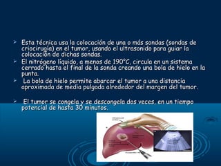 







Esta técnica usa la colocación de una o más sondas (sondas de
criocirugía) en el tumor, usando el ultrasonido para guiar la
colocación de dichas sondas.
El nitrógeno líquido, a menos de 190°C, circula en un sistema
cerrado hasta el final de la sonda creando una bola de hielo en la
punta.
La bola de hielo permite abarcar el tumor a una distancia
aproximada de media pulgada alrededor del margen del tumor.
El tumor se congela y se descongela dos veces, en un tiempo
potencial de hasta 30 minutos.

 