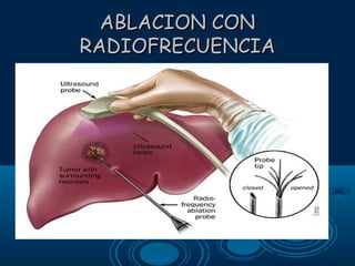 ABLACION CON
RADIOFRECUENCIA

 