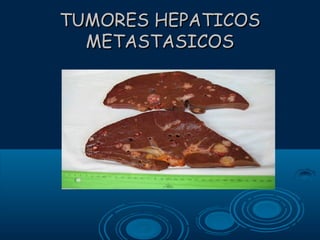 TUMORES HEPATICOS
METASTASICOS

 