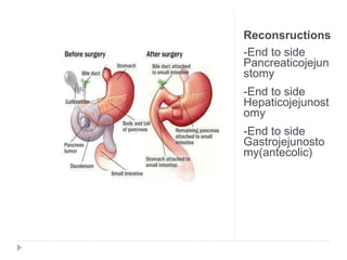Reconsructions
-End to side
Pancreaticojejun
stomy
-End to side
Hepaticojejunost
omy
-End to side
Gastrojejunosto
my(antecolic)
 