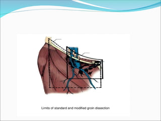 CARCINOMA PENIS powerpoint presentations
