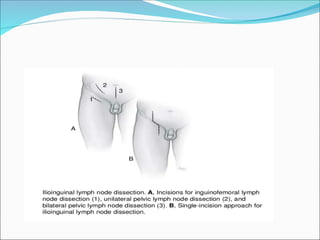 CARCINOMA PENIS powerpoint presentations