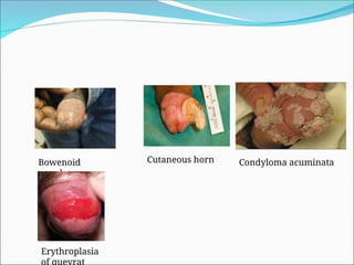 Bowenoid
papules
Cutaneous horn Condyloma acuminata
Erythroplasia
of queyrat
 