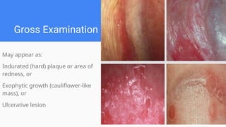 Gross Examination
May appear as:
Indurated (hard) plaque or area of
redness, or
Exophytic growth (cauliflower-like
mass), or
Ulcerative lesion
 