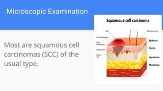 Microscopic Examination
Most are squamous cell
carcinomas (SCC) of the
usual type.
 