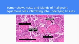 Tumor shows nests and islands of malignant
squamous cells infiltrating into underlying tissues.
 