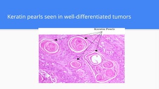 Keratin pearls seen in well-differentiated tumors
 
