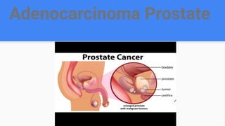 Adenocarcinoma Prostate
 