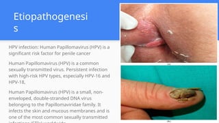 Etiopathogenesi
s
HPV infection: Human Papillomavirus (HPV) is a
significant risk factor for penile cancer
Human Papillomavirus (HPV) is a common
sexually transmitted virus. Persistent infection
with high-risk HPV types, especially HPV-16 and
HPV-18,
Human Papillomavirus (HPV) is a small, non-
enveloped, double-stranded DNA virus
belonging to the Papillomaviridae family. It
infects the skin and mucous membranes and is
one of the most common sexually transmitted
 