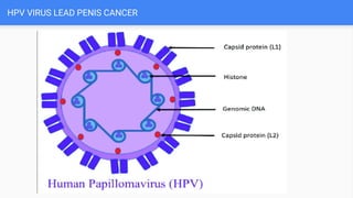 HPV VIRUS LEAD PENIS CANCER
 