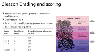 Carcinoma Prostate power point presentation | PPTX