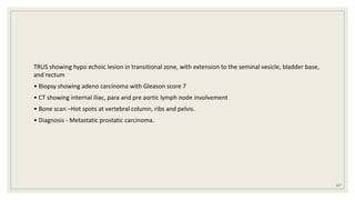 TRUS showing hypo echoic lesion in transitional zone, with extension to the seminal vesicle, bladder base,
and rectum
• Biopsy showing adeno carcinoma with Gleason score 7
• CT showing internal iliac, para and pre aortic lymph node involvement
• Bone scan –Hot spots at vertebral column, ribs and pelvis.
• Diagnosis - Metastatic prostatic carcinoma.
127
 