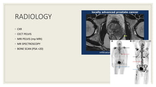 RADIOLOGY
◦ CXR
◦ CECT PELVIS
◦ MRI PELVIS (mp MRI)
◦ MR SPECTROSCOPY
◦ BONE SCAN (PSA >20)
23
 