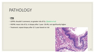 PATHOLOGY
◦ PIN
◦ LGPIN: shouldn’t comment, no greater risk of Ca. (Epstein et al)
◦ HGPIN: mean risk of Ca. in biopsy after 1 year- 26.4%, not significantly higher
◦ Treatment: repeat biopsy after 3/ 1 year based on risk
29
 