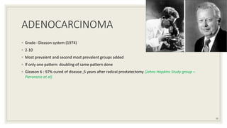 ADENOCARCINOMA
◦ Grade- Gleason system (1974)
◦ 2-10
◦ Most prevalent and second most prevalent groups added
◦ If only one pattern: doubling of same pattern done
◦ Gleason 6 : 97% cured of disease ,5 years after radical prostatectomy (Johns Hopkins Study group –
Pierorazio et al)
30
 