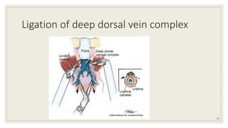 Ligation of deep dorsal vein complex
60
 