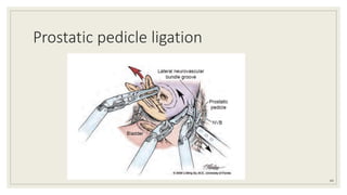 Prostatic pedicle ligation
64
 