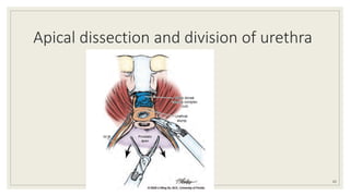Apical dissection and division of urethra
65
 