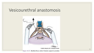 Vesicourethral anastomosis
66
 