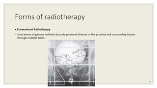 Forms of radiotherapy
• Conventional Radiotherapy
◦ Uses beams of gamma radiation (usually photons) directed at the prostate and surrounding tissues
through multiple fields
74
 
