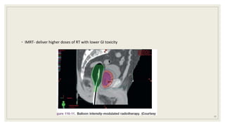 ◦ IMRT- deliver higher doses of RT with lower GI toxicity
77
 