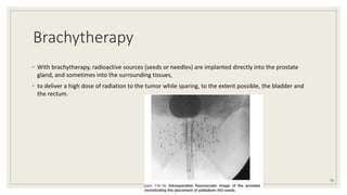 Brachytherapy
◦ With brachytherapy, radioactive sources (seeds or needles) are implanted directly into the prostate
gland, and sometimes into the surrounding tissues,
◦ to deliver a high dose of radiation to the tumor while sparing, to the extent possible, the bladder and
the rectum.
79
 