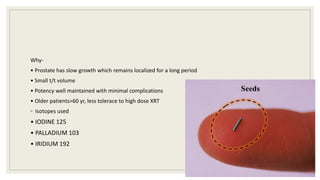 Why-
• Prostate has slow growth which remains localized for a long period
• Small t/t volume
• Potency well maintained with minimal complications
• Older patients>60 yr, less tolerace to high dose XRT
◦ Isotopes used
• IODINE 125
• PALLADIUM 103
• IRIDIUM 192
80
 