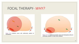 FOCAL THERAPY- WHY?
84
 
