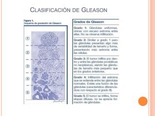 CLASIFICACIÓN DE GLEASON
 