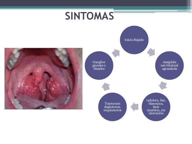 carcinoma epidermoide de amigdala pdf carcinoma epidermoide de amigdala pdf