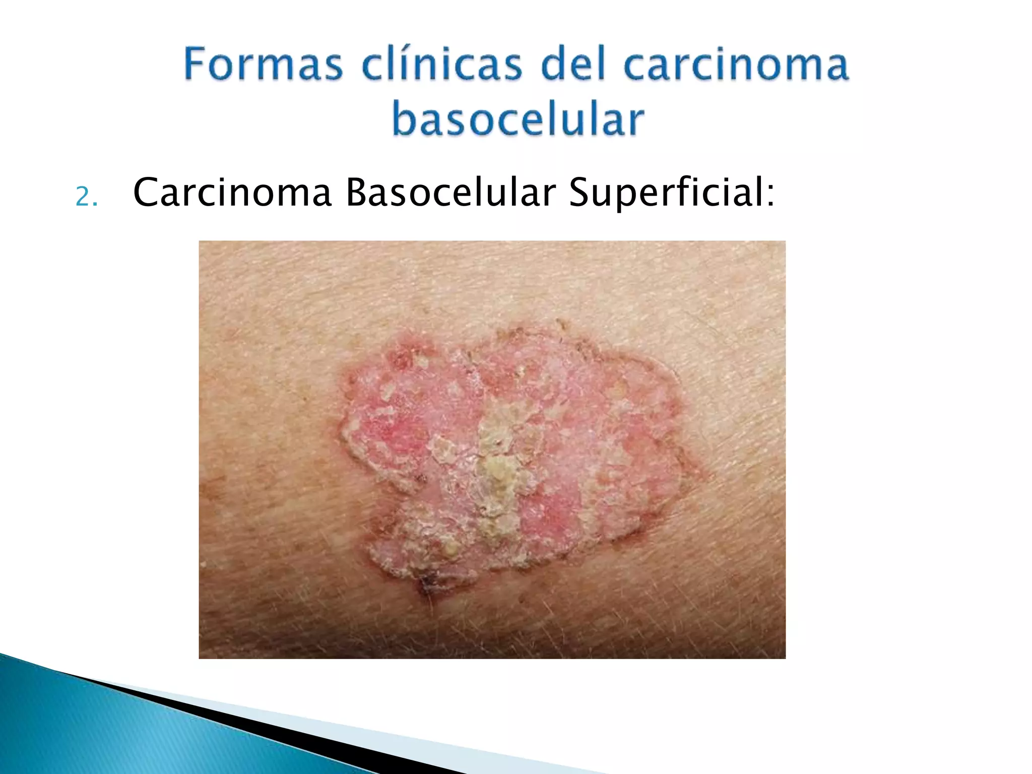 Carcinoma basocelular y espinocelular | PPTX
