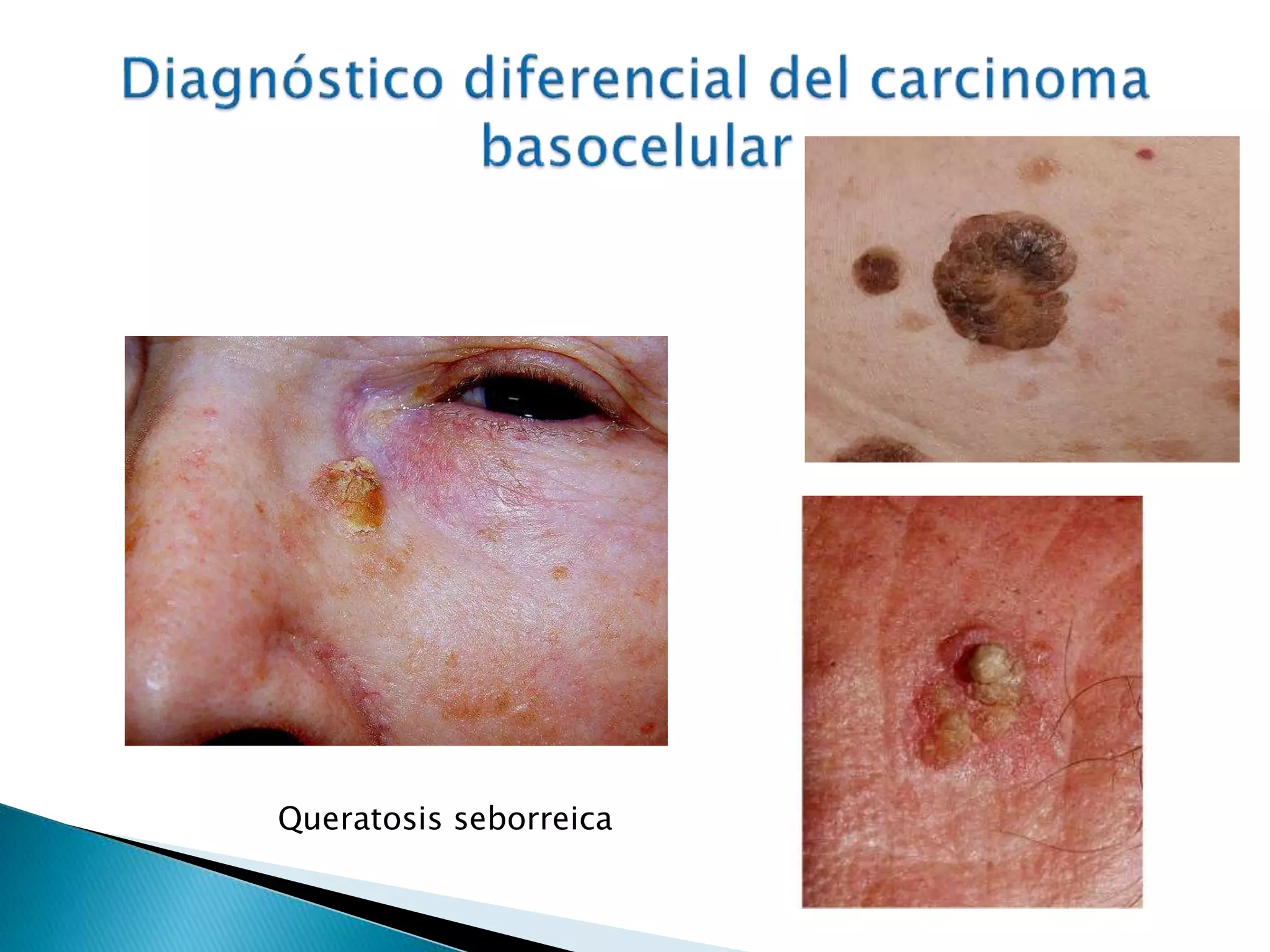 Carcinoma Basocelular Y Espinocelular PPTX carcinoma-basocelular-y-espinocelular-pptx