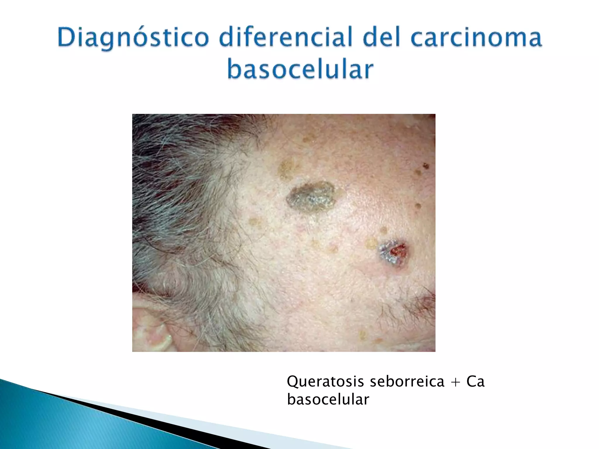 Carcinoma Basocelular Y Espinocelular PPTX carcinoma-basocelular-y-espinocelular-pptx