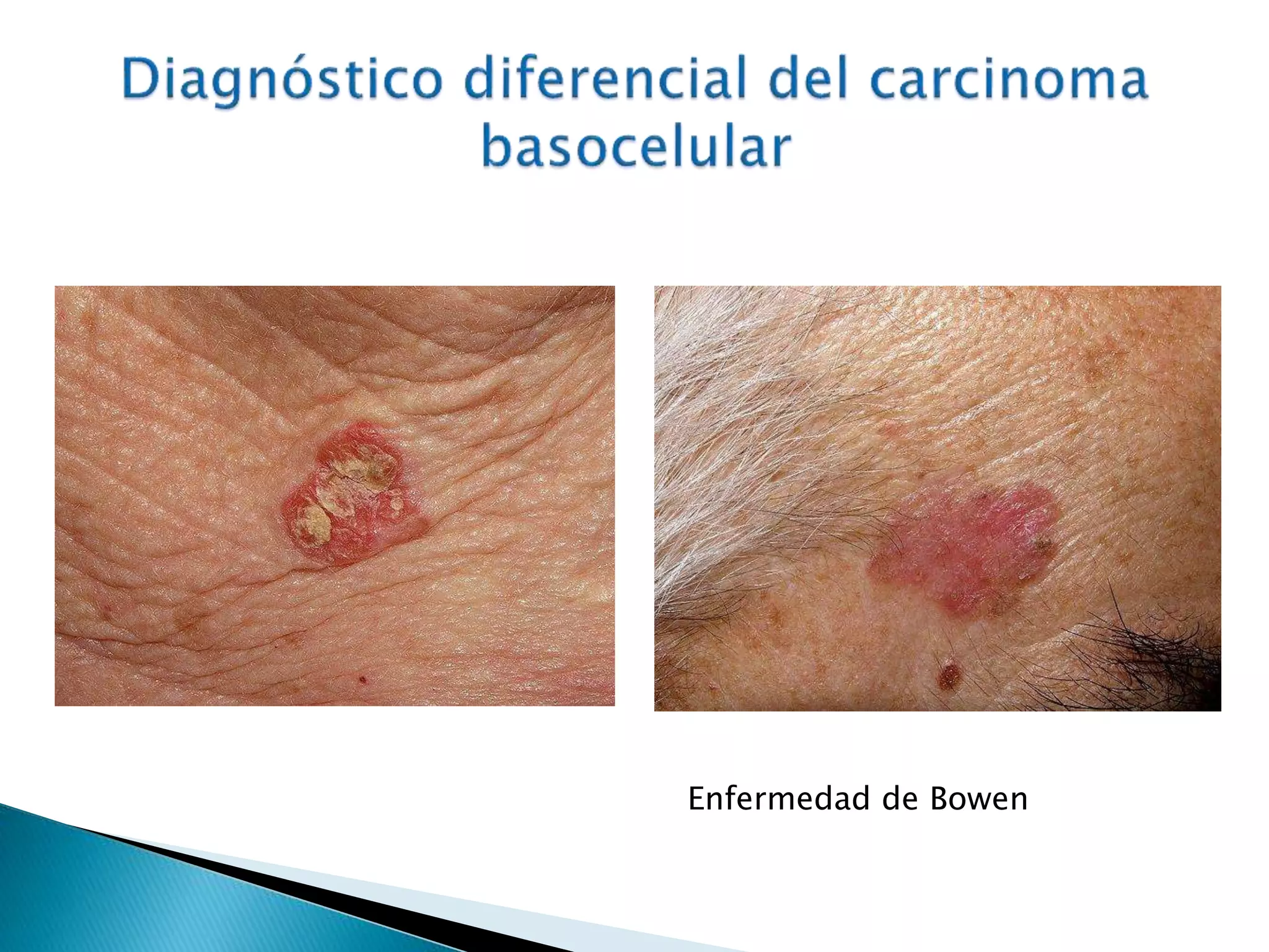 Carcinoma basocelular y espinocelular | PPTX