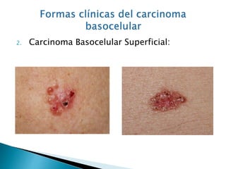 Carcinoma Basocelular Y Espinocelular PPTX carcinoma-basocelular-y-espinocelular-pptx