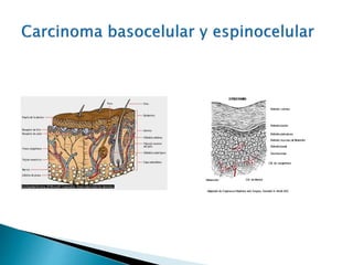 Carcinoma Basocelular Y Espinocelular PPTX carcinoma-basocelular-y-espinocelular-pptx