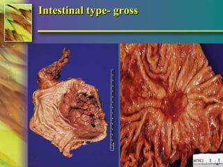 Intestinal type- gross 
© 2004, 2002 Elsevier Inc. All rights reserved. 
 
