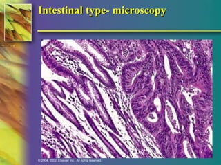Intestinal type- microscopy 
© 2004, 2002 Elsevier Inc. All rights reserved. 
 