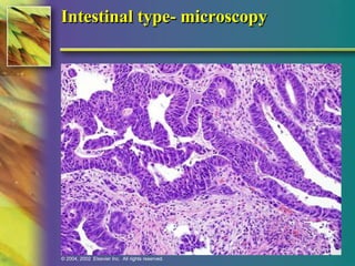Intestinal type- microscopy 
© 2004, 2002 Elsevier Inc. All rights reserved. 
 