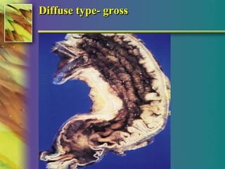 Diffuse type- gross 
© 2004, 2002 Elsevier Inc. All rights reserved. 
 