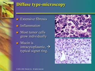 Diffuse type-microscopy 
 Extensive fibrosis 
 Inflammation 
 Most tumor cells 
grow individually 
 Mucin is 
intracytoplasmic,  
typical signet ring. 
© 2004, 2002 Elsevier Inc. All rights reserved. 
 
