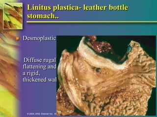Linitus plastica- leather bottle 
stomach.. 
 Desmoplastic 
Diffuse rugal 
flattening and 
a rigid, 
thickened wall 
© 2004, 2002 Elsevier Inc. All rights reserved. 
 