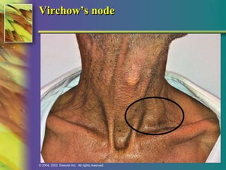 Virchow’s node 
© 2004, 2002 Elsevier Inc. All rights reserved. 
 