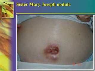 Sister Mary Joseph nodule 
© 2004, 2002 Elsevier Inc. All rights reserved. 
 