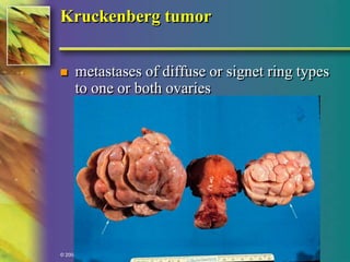 Kruckenberg tumor 
 metastases of diffuse or signet ring types 
to one or both ovaries 
© 2004, 2002 Elsevier Inc. All rights reserved. 
 
