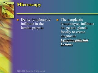 Microscopy 
 Dense lymphocytic 
infiltrate in the 
lamina propria 
© 2004, 2002 Elsevier Inc. All rights reserved. 
 The neoplastic 
lymphocytes infiltrate 
the gastric glands 
focally to create 
diagnostic 
Lymphoepithelial 
Lesions 
 
