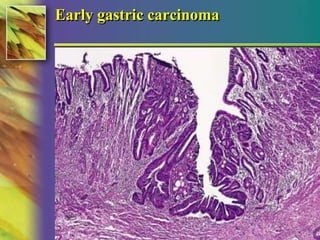 Early gastric carcinoma 
© 2004, 2002 Elsevier Inc. All rights reserved. 
 