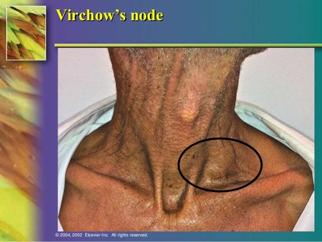 Carcinoma stomach