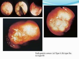 Early gastric cancer. (a) Type I; (b) type IIa;
(c) type III
 